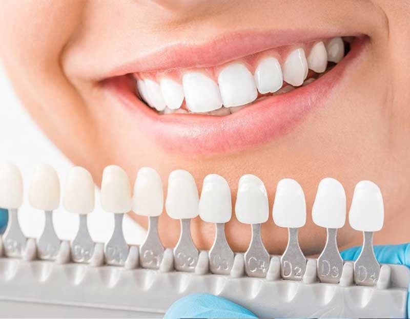 E-max Veneers