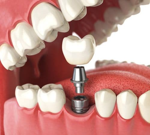 Dental Implants